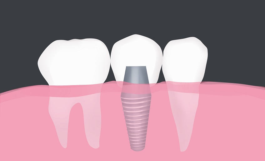 dental implant restoration port washington ny